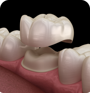 <a style="color:#000;text-decoration:none;" href="https://dentalfirst.care/en/services/#sedation-13">Crowns and Dental Bridges</a>