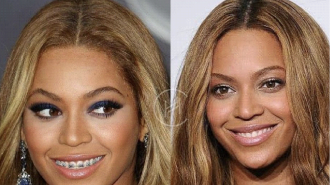 beyoncé dientes carillas