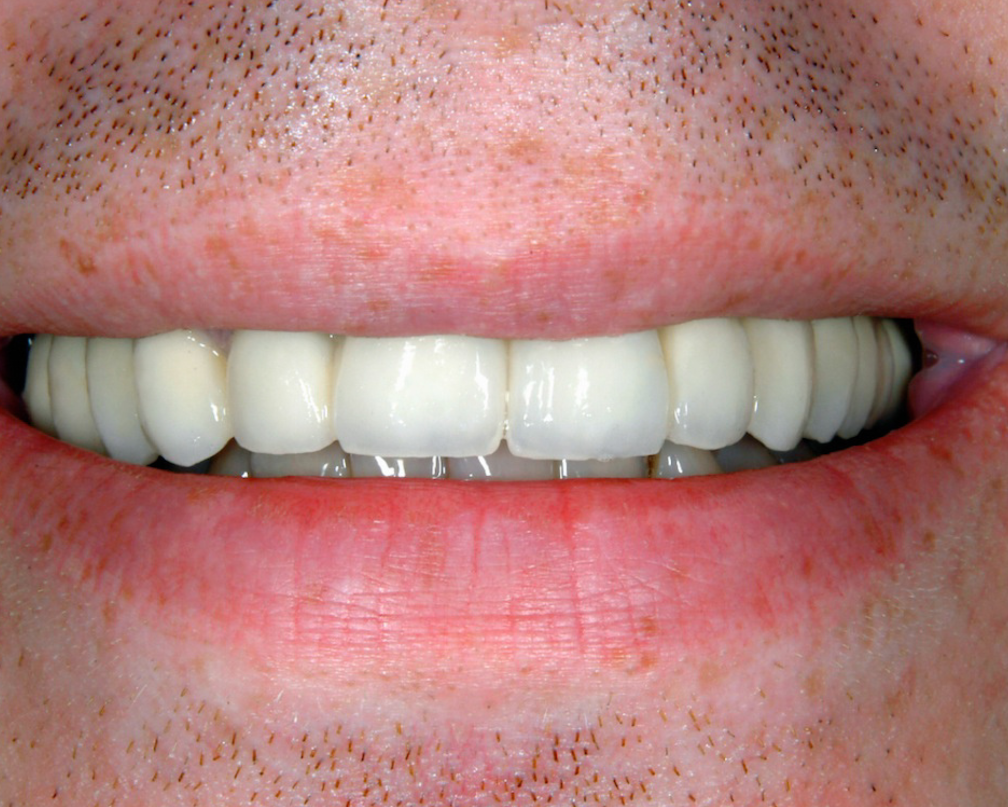 Patient 2 After