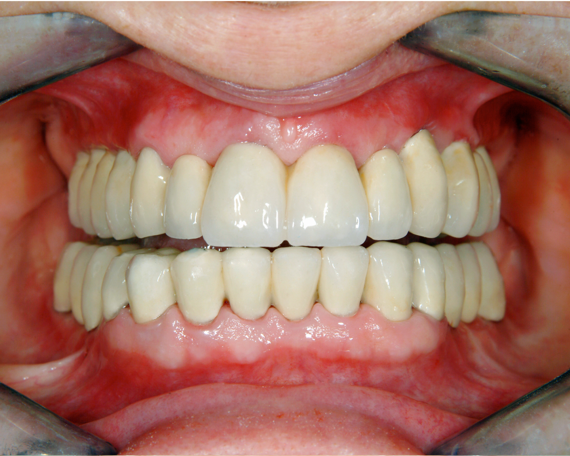 Restored Smile